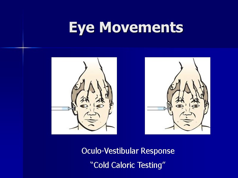 Eye Movements Oculo-Vestibular Response “Cold Caloric Testing”